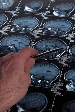 A hand points with a pen at multiple MRI scans displaying sagittal views of human brains.