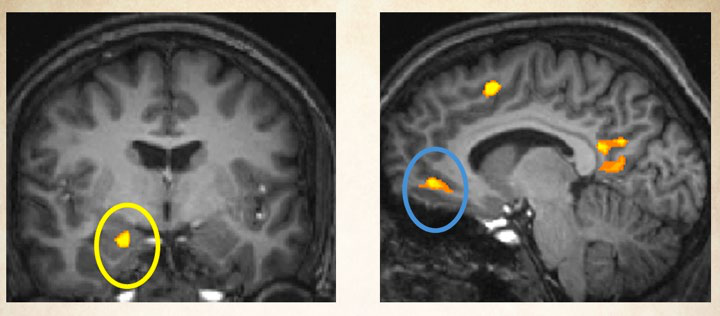 Two brain scans showing highlighted areas of activity. The left image is a coronal view with a yellow circle, and the right is a sagittal view with a blue circle.